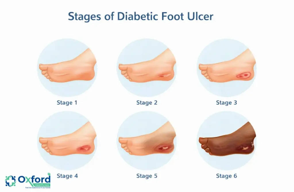 Stages of diabetic foot ulcer
